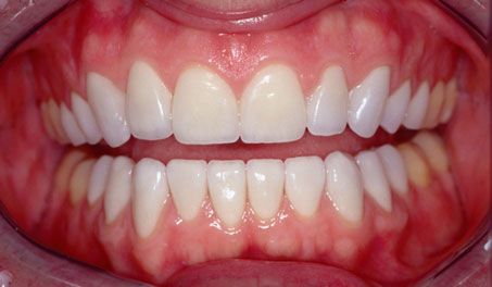 Dr. Bidra's patient after veneers