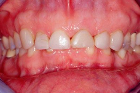 worn teeth