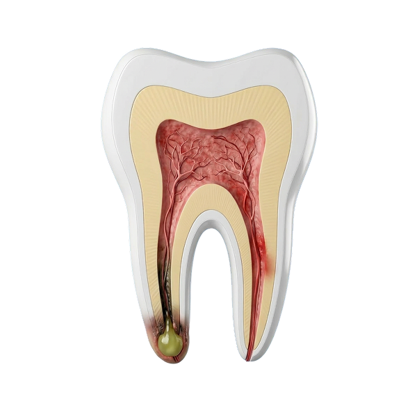 tooth infection