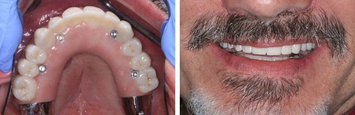All-on-4 revision case completed by Dr. Bidra