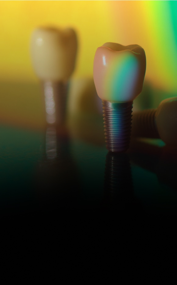 Dental&nbsp; Implants