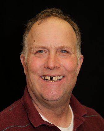 Mike before dental crowns