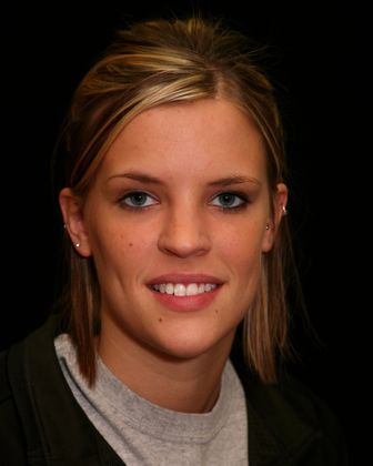 Dr. Everett E. Heringer's patient before veneer placement