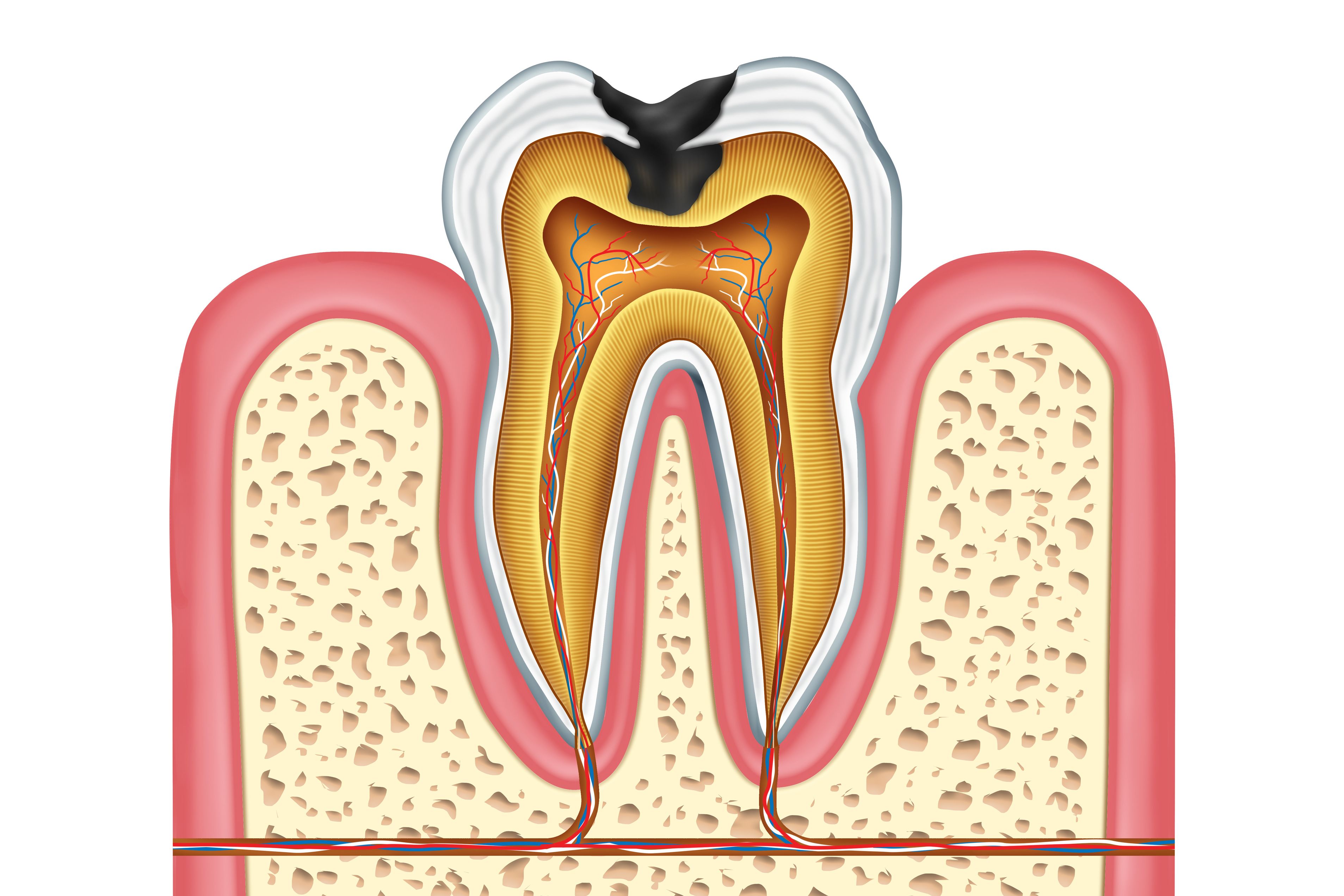 Удаление нерва зуба сколько болит