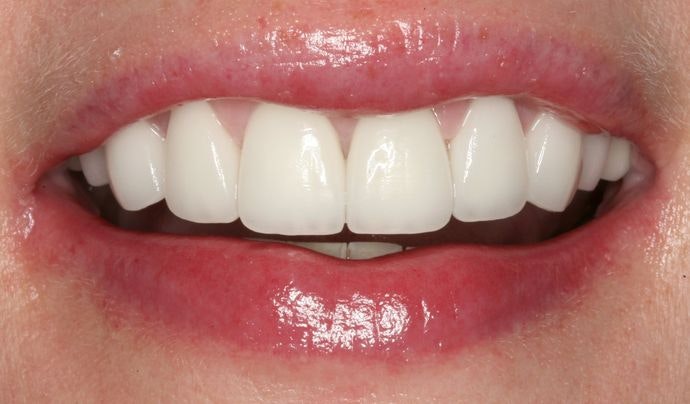Dr. Heringer's patient after dental crowns