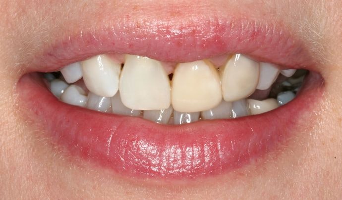 Dr. Heringer's patient before dental crowns