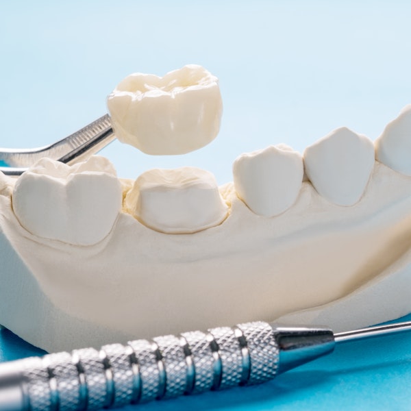 a traditional crown on a tooth model