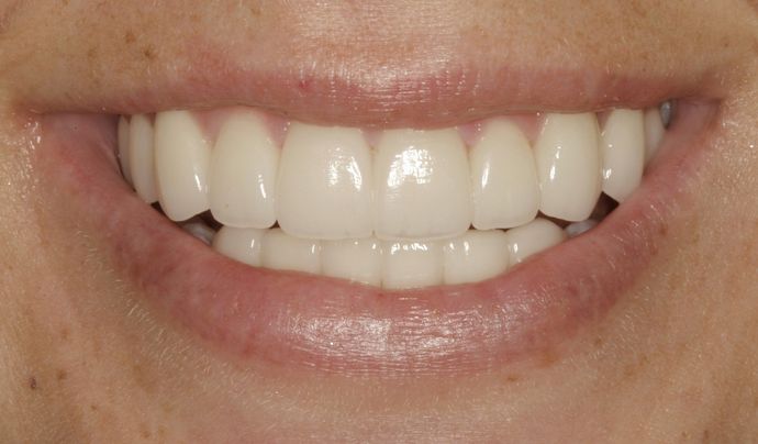 After Case 1's porcelain veneers treatment