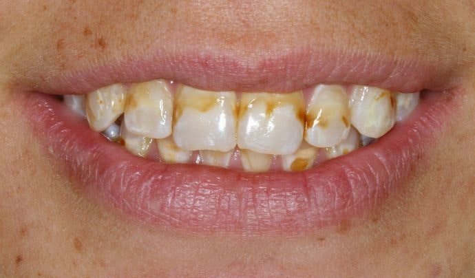 Before Case 1's porcelain veneers treatment
