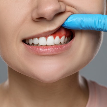 Gloved hand lifting person's lip to show red and inflamed gums