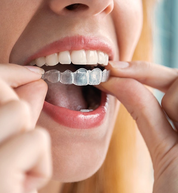invisalign