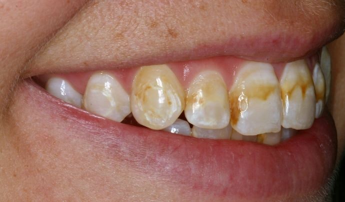 discolored teeth