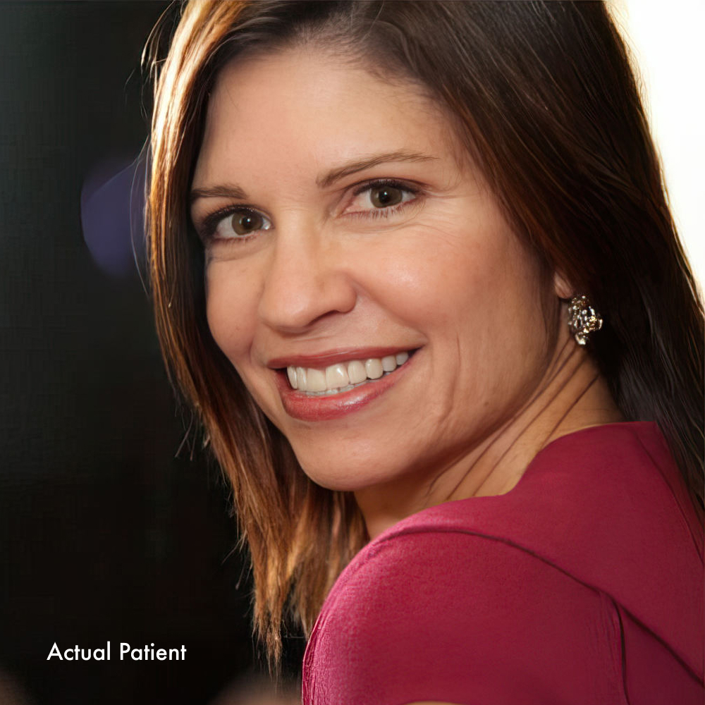 woman with veneers smiling