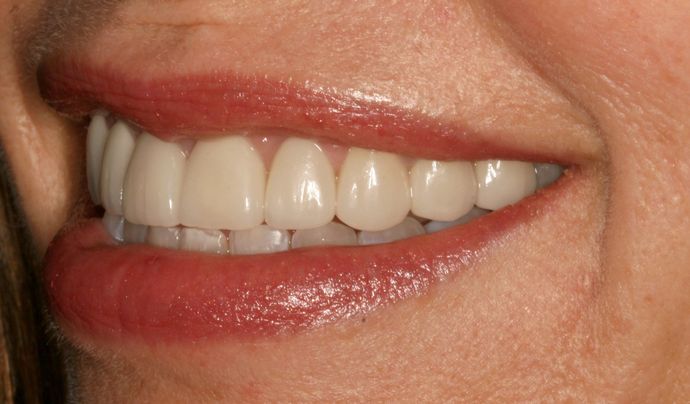 after veneers
