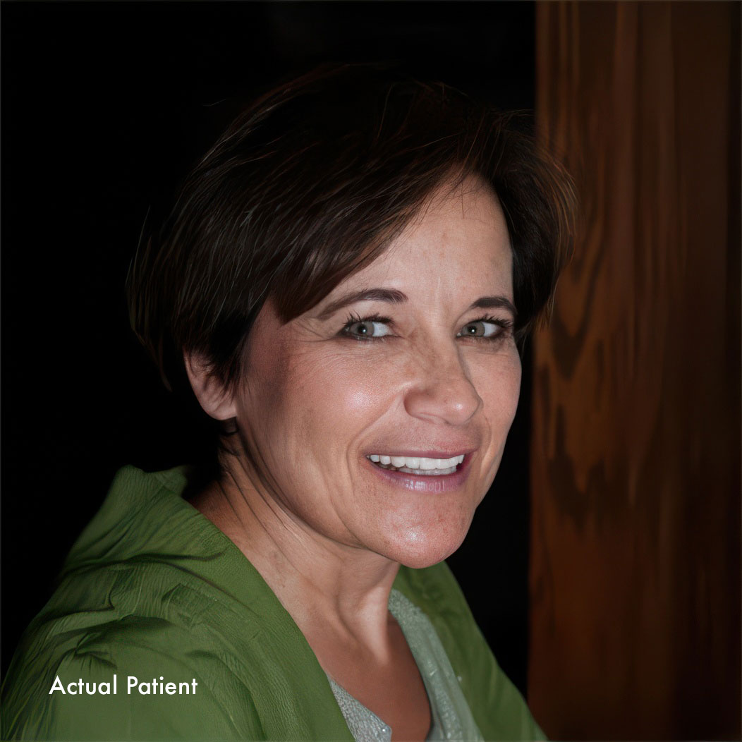 Case 3 Porcelain Veneers