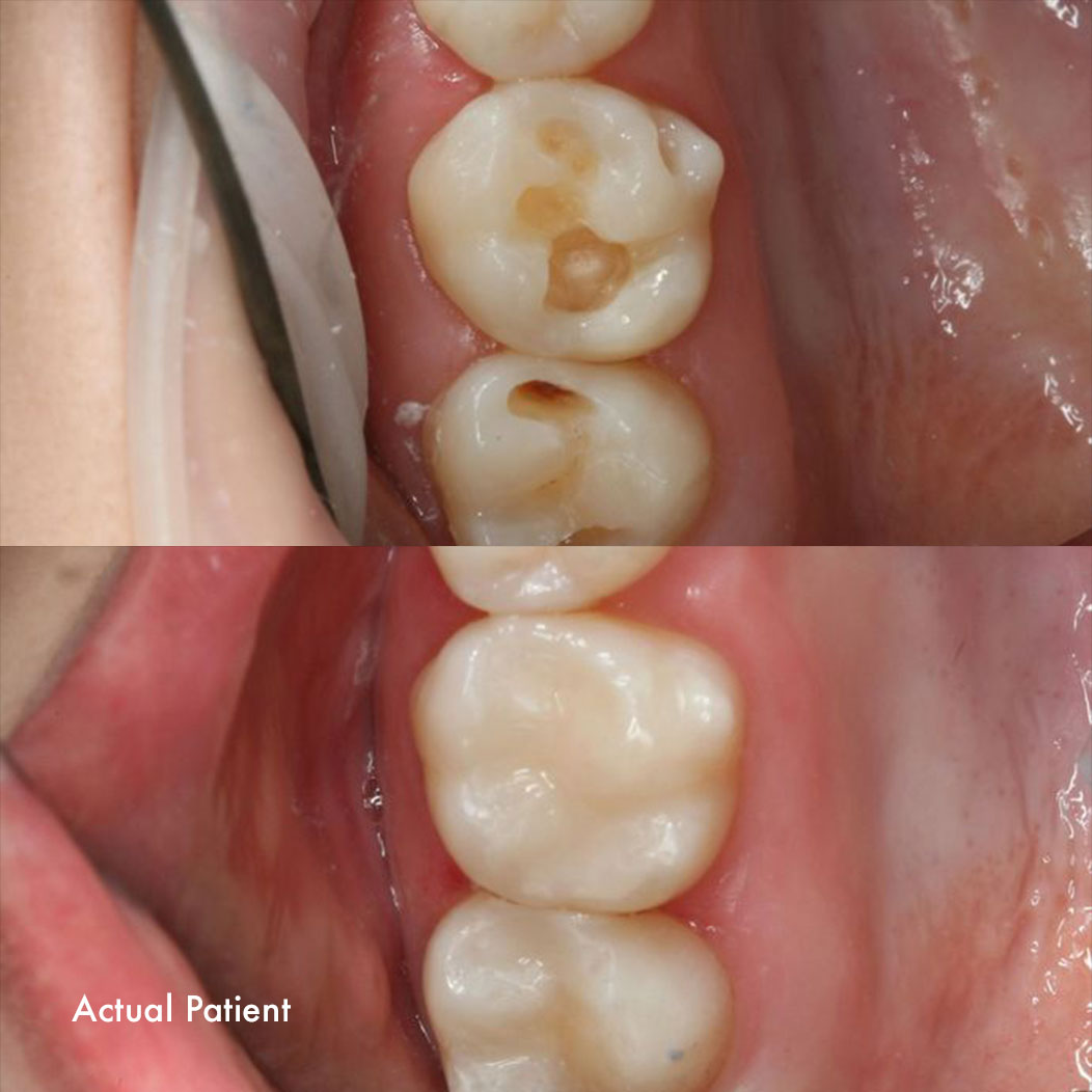 Close up of a tooth before and after a filling