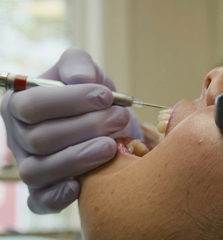teeth cleaning