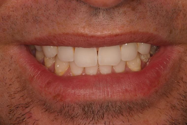 Artistic Expressions Dentistry patient before veneers