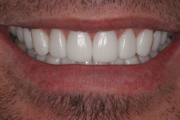 Artistic Expressions Dentistry patient after veneers