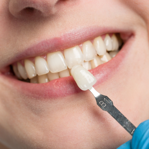 Matching veneer to a patient's teeth