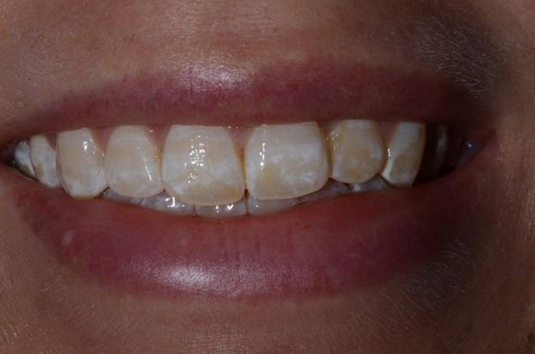 Case 2 before Smile Makeover