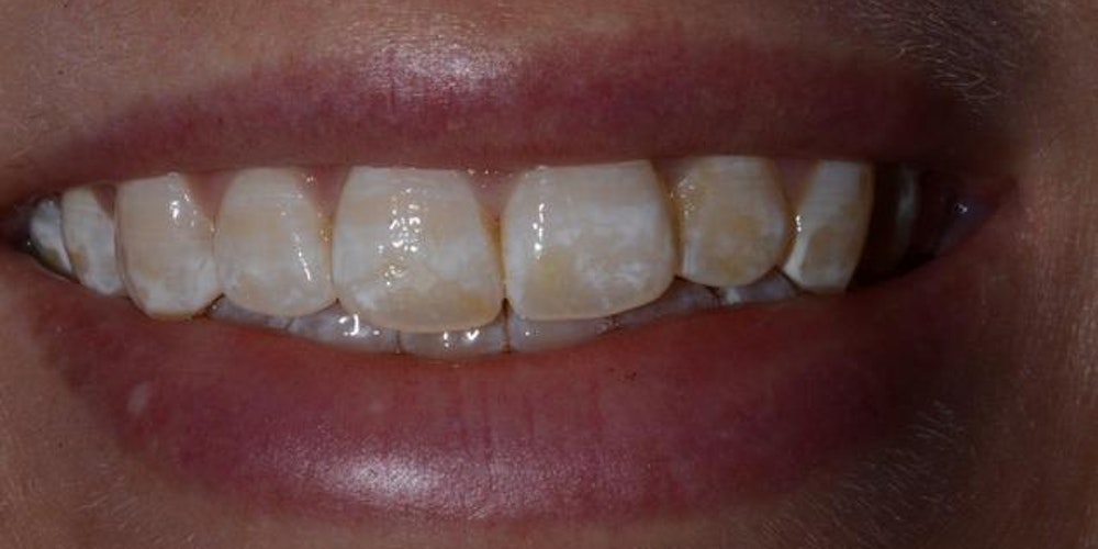 Case 2 before Smile Makeover