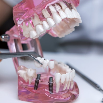 dental bridge