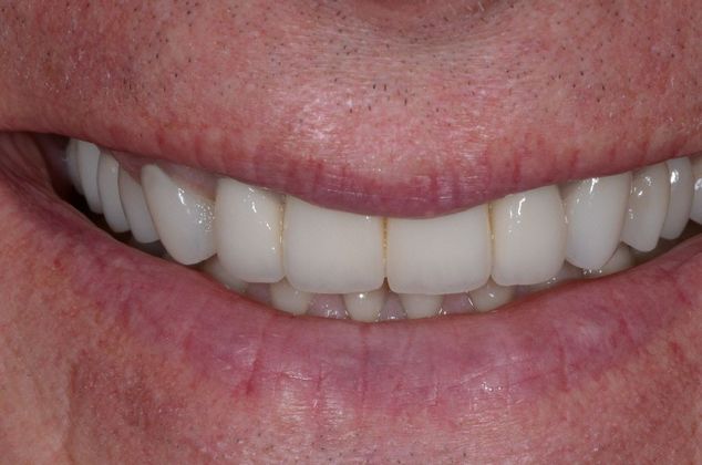 after veneers