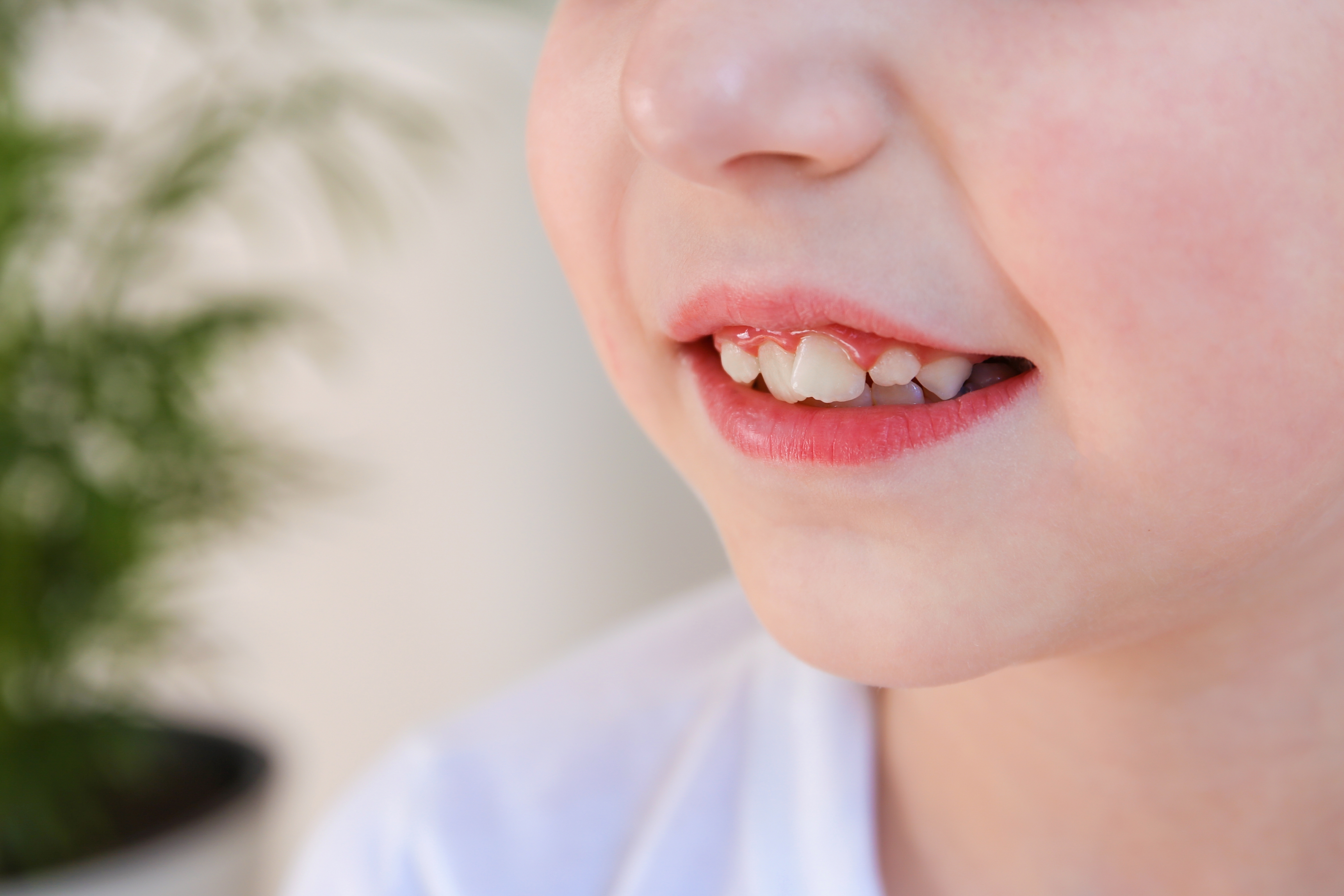 Close-up of child's mouth with molar crowding