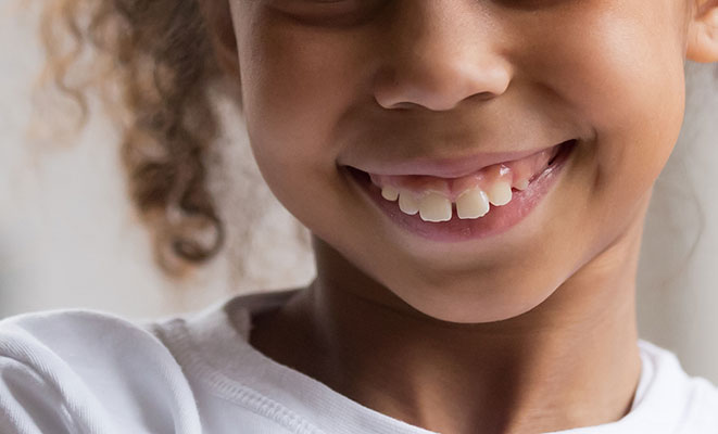 Young girl with an overbite