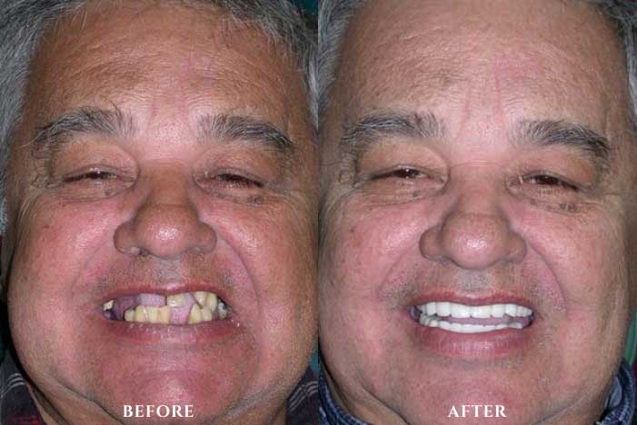 Smile Makeover Before and After Photo