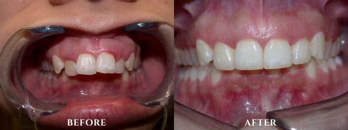 Invisalign Patient Before and After Photo
