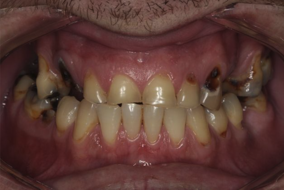 Before dental treatment