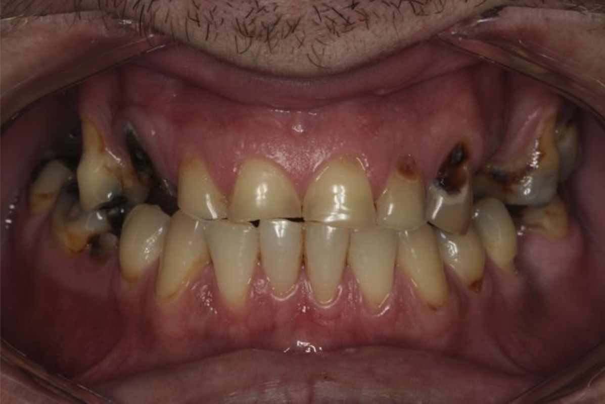 Before dental treatment