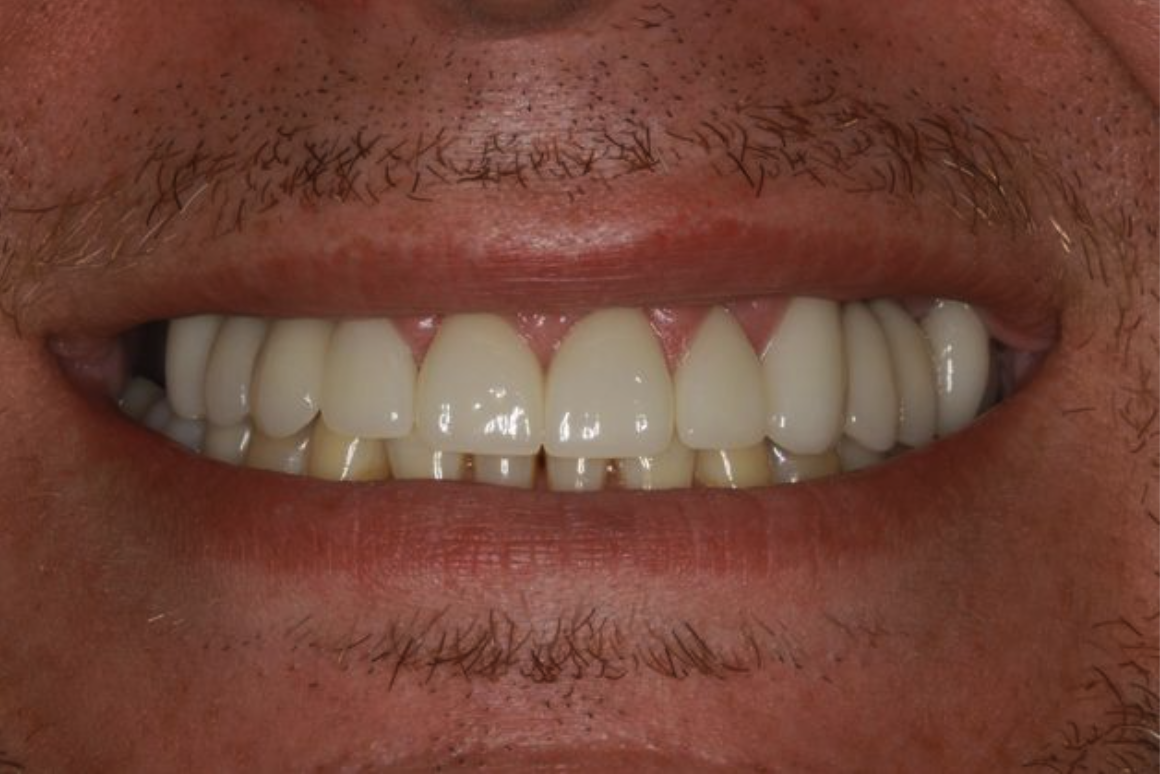 After dental treatment