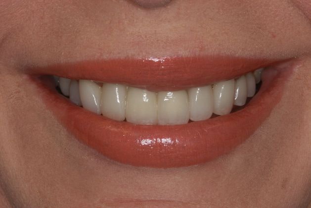 After dental crowns