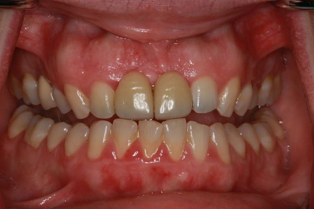 Before dental crowns