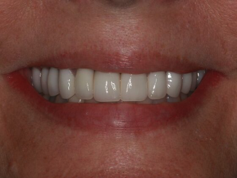 After dental implants