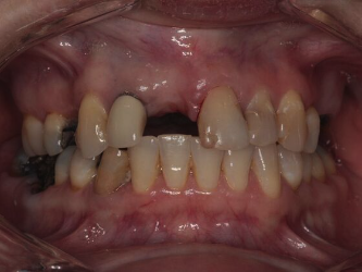 Before dental implants