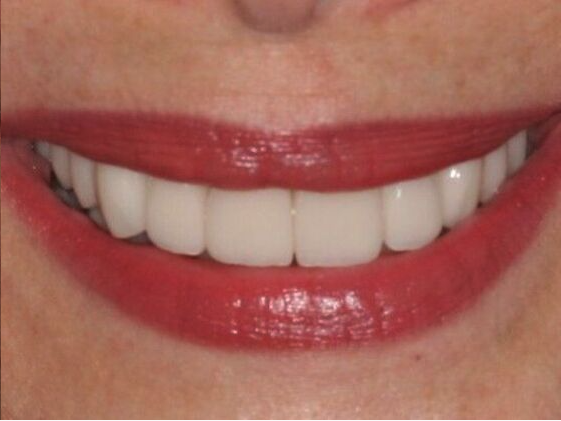 After Veneers