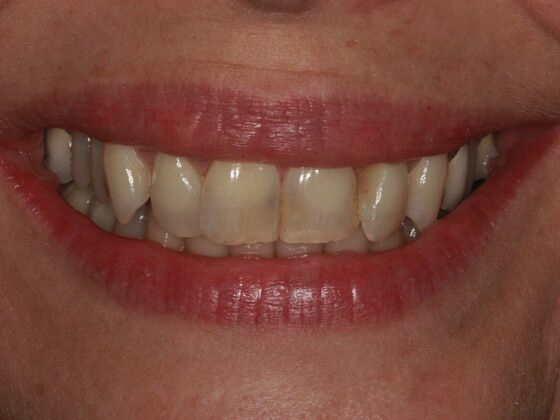 Before Veneers