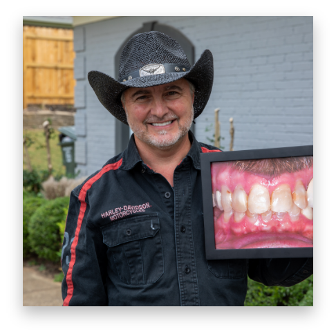 Dr. Collier's patient before and after full mouth reconstruction