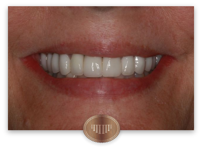 Dr. Jason Collier's patient after cosmetic dentistry