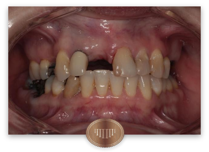 Dr. Jason Collier's patient before cosmetic dentistry
