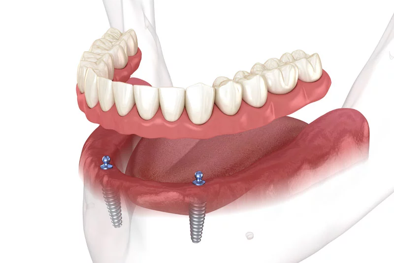 Implant Supported Dentures model