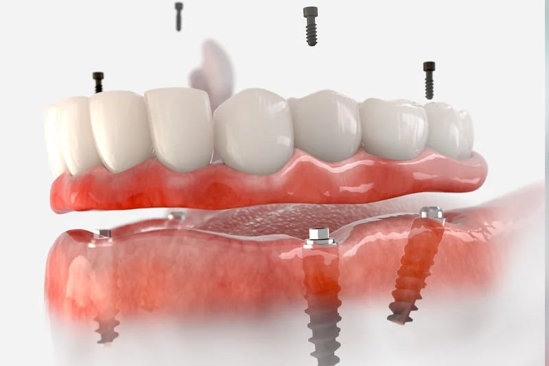 Full Arch Fixed Teeth model