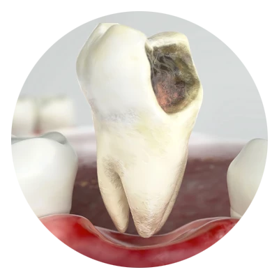 tooth extraction model