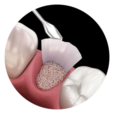 socket preservation model