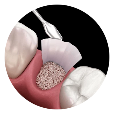 socket preservation model
