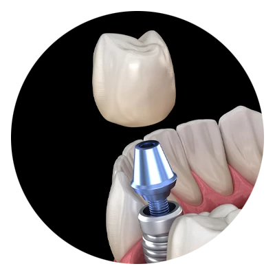 Dental Implant Model